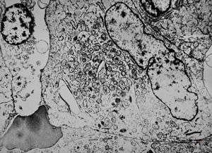 F,76y. | unspecified sarcoma (myocarcoma v.s.) - calf F,76y. | unspecified sarcoma (myocarcoma v.s.) - calf